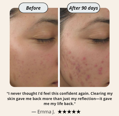 Hormonal Acne Supplement